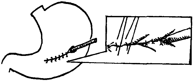 一、消化道轉(zhuǎn)流改道和造瘺置管術(shù)